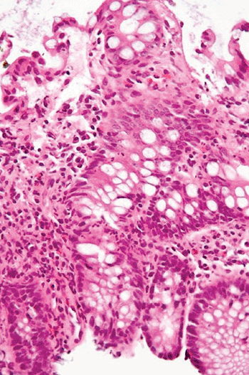 Image: Micrograph of cryptitis in a case of Inflammatory Bowel Disease from a colonic biopsy of the mucosa (Photo courtesy of Nephron).